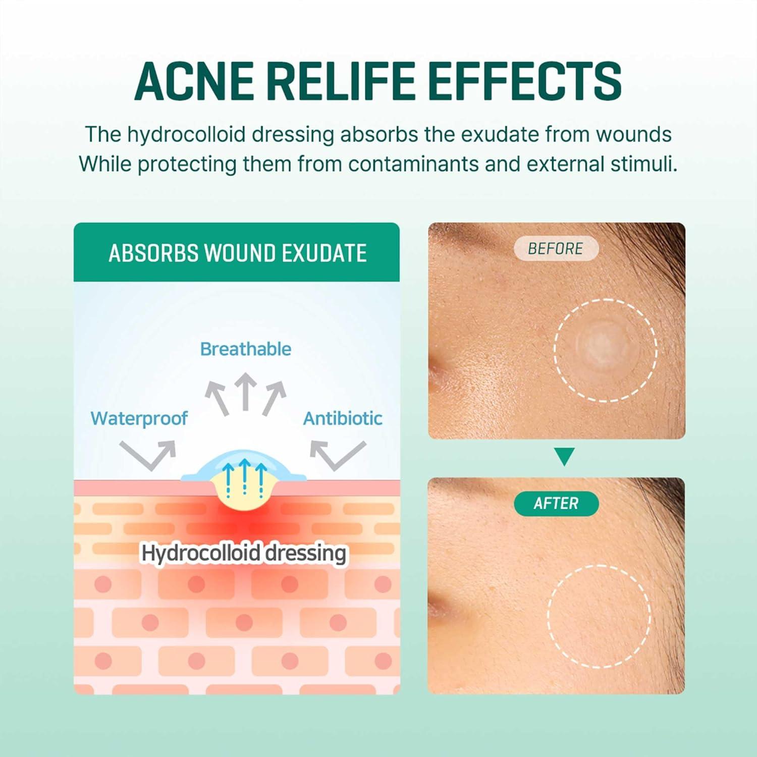 Some By Mi 30 days miracle clear spot patch - 18 patches